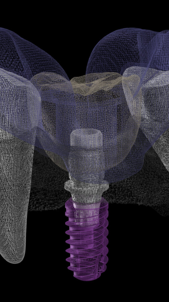3D dental implant model with transparent layers